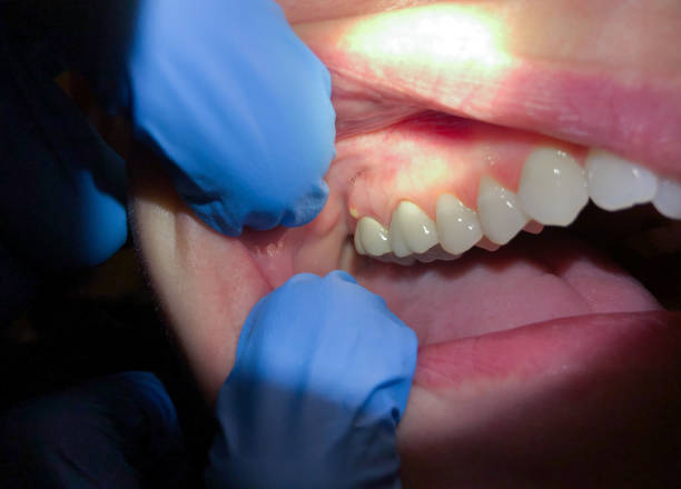 Best Emergency Dental Extractions in Spring Hope, NC